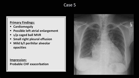 validity of chest x ray result